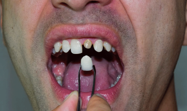 مراحل کامل کاشت ایمپلنت دندان