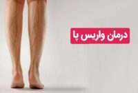 خداحافظی با درد و سنگینی پاها | درمان قطعی واریس