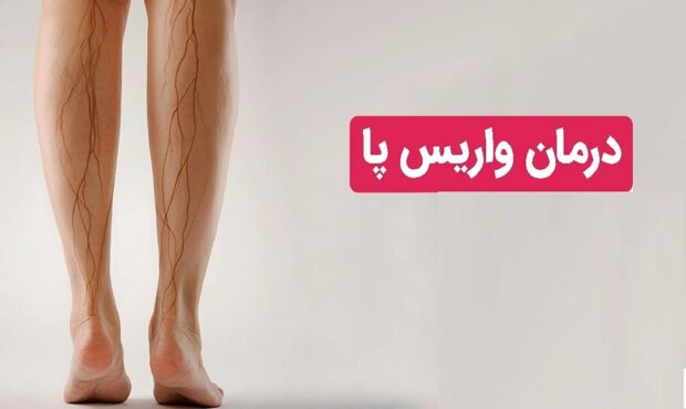 خداحافظی با درد و سنگینی پاها | درمان قطعی واریس خداحافظی با درد و سنگینی پاها | درمان قطعی واریس