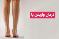 درمان واریس در کمترین زمان با بهترین متخصص واریس