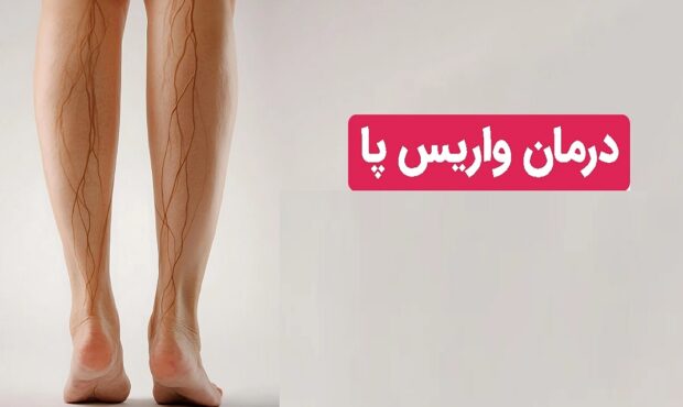 درمان واریس در کمترین زمان با بهترین متخصص واریس